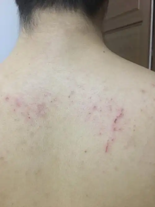 254lv7 擅长:暂未定制 向ta提问私信ta  展开全部 应该是皮炎,你后背