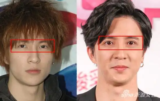 对比虽然之前也是大宽双眼皮,可是眼睛总是感觉木有睁开,然而现在又圆