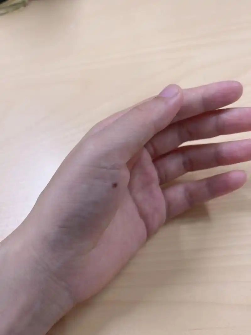 左手突然长了一个痣 左手突然长了一个痣"曾听老人说,左手 有痣,代表