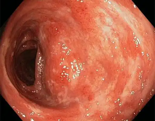 肛癌早期症状图片 (11)_有来医生