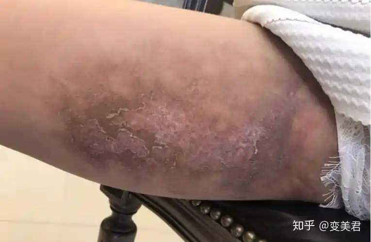 淤青严重导致的部位皮肤坏死抽脂过程中,如果医生不了解皮肤层的结构