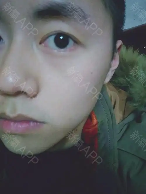 眼皮上一直有一个小疙瘩