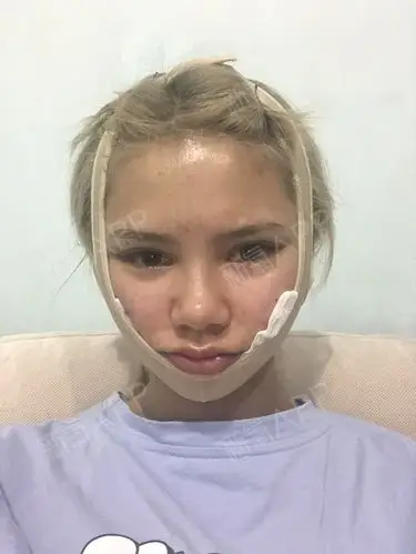 【面部吸脂项目术后第7天】 给大家说说术后恢复的事_圈子-新氧美容