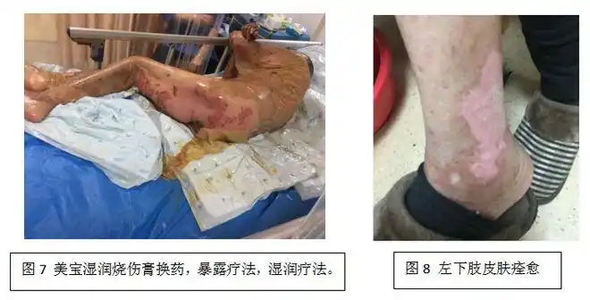 一例左氧氟沙星致大疱表皮松解坏死型药疹的护理