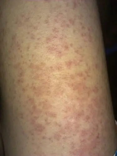 去地方人民医院看医生,医生说过敏性皮炎,打了几天过敏性针和擦了几种