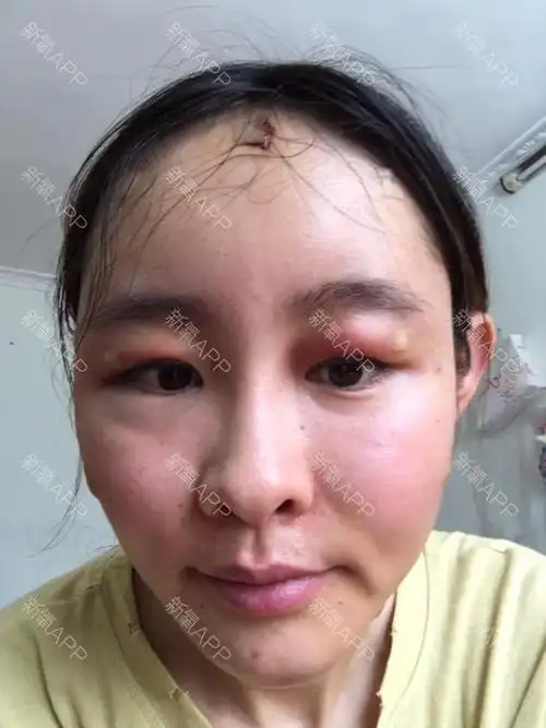 自体脂肪面部填充