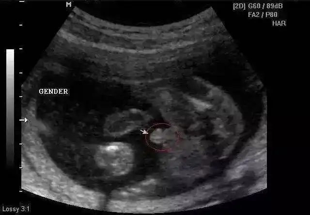 12周胎儿男女生殖图区别图