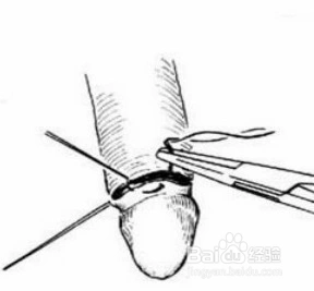 包皮手术过程