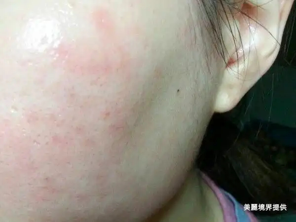 春天换季脸红红