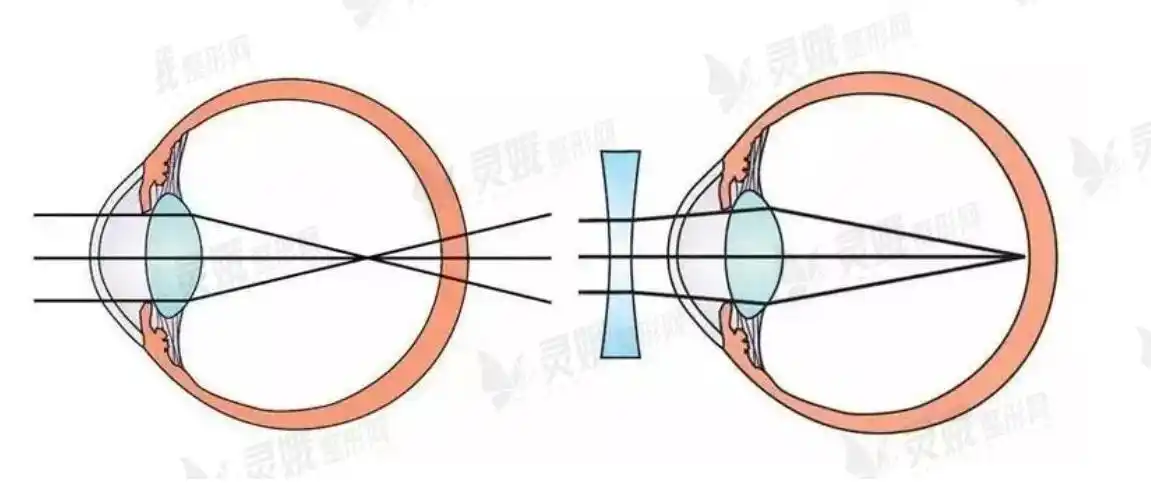 近视眼矫正多久恢复手术原理是什么术后有什么注意事项吗