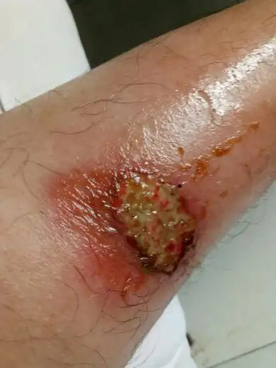 小腿被摩托车烫伤,正赶上老婆生孩子(刨腹产)照顾她没关心腿的事.