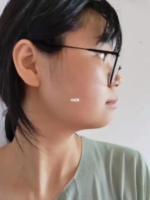 一年牙套侧脸对比图