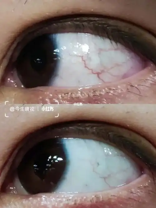 眼睛出现红血丝不只是眼疲劳呦,人眼里布满了特别 细微的血管,一般