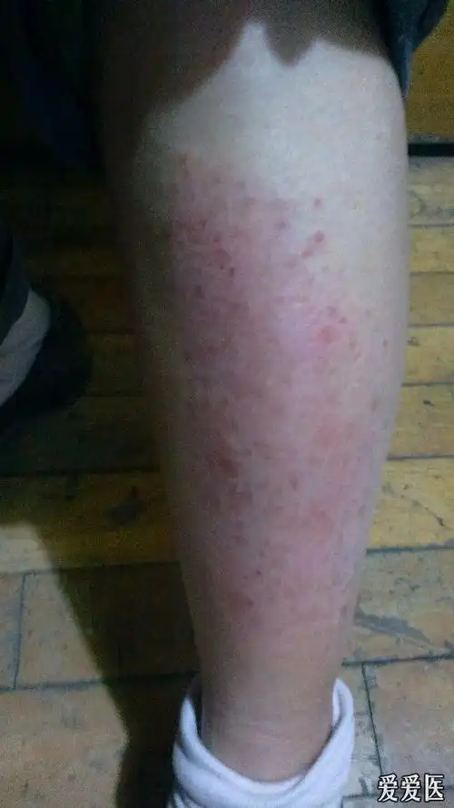 看图识病胫前黑斑