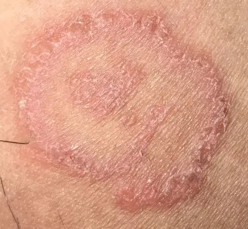 在大腿内侧,其他地方都没有,很痒,是皮肤过敏还是湿疹啊?,谢谢