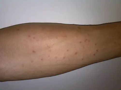 我父亲55岁,最近一周两只胳膊上一直有很多红疹,很