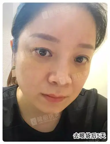 去眼袋 泪沟的逆龄效果真的很明显这样