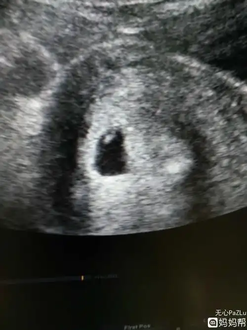 孕几周查胎心胎芽(孕几周查胎心胎芽合适)