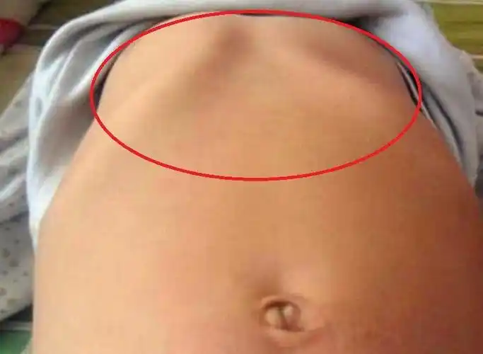 3岁孩子缺钙导致鸡胸得知原因妈妈自责宝宝补钙不可忽视