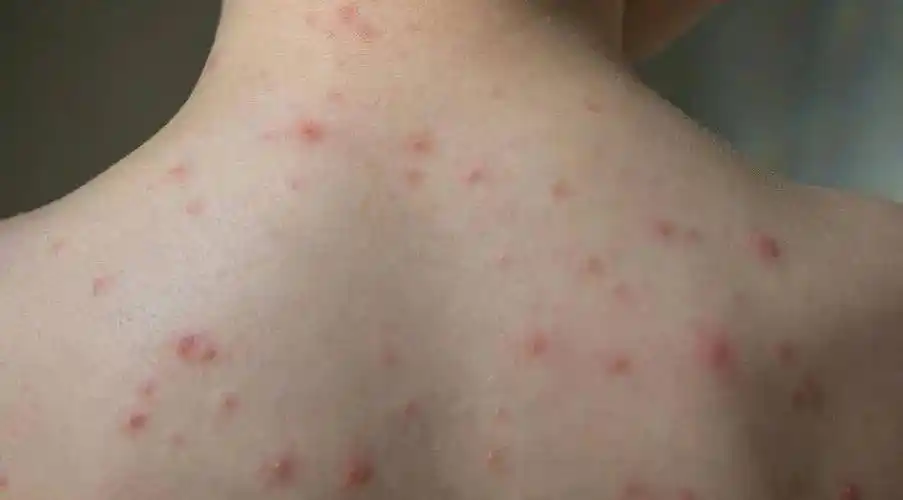 辽宁鞍山:有学生感染水痘