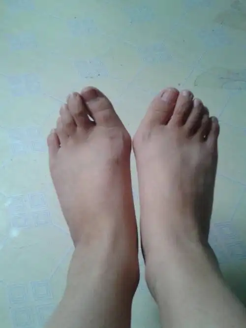 问:17岁女先天拇外翻,适合手术还是物理矫正?