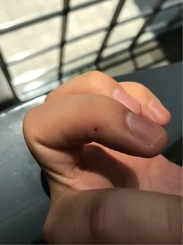 手指突然长了个痣是什么情况