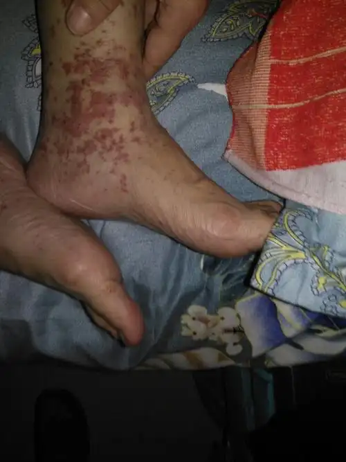 父亲两条腿长很多红斑,症状有一个星期了.请问这是什么属于什么病?