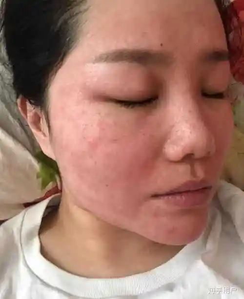 如何改善脸上皮肤特别薄,一直泛红,毛孔粗大,红血丝明显? - 知乎