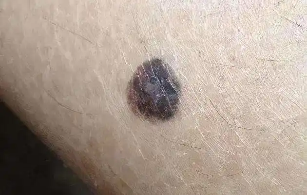 提醒如果黑痣长在这4个部位要提高警惕或要早做检查