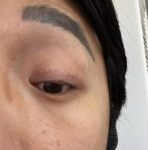 双眼皮埋线后眼皮有疙瘩结节