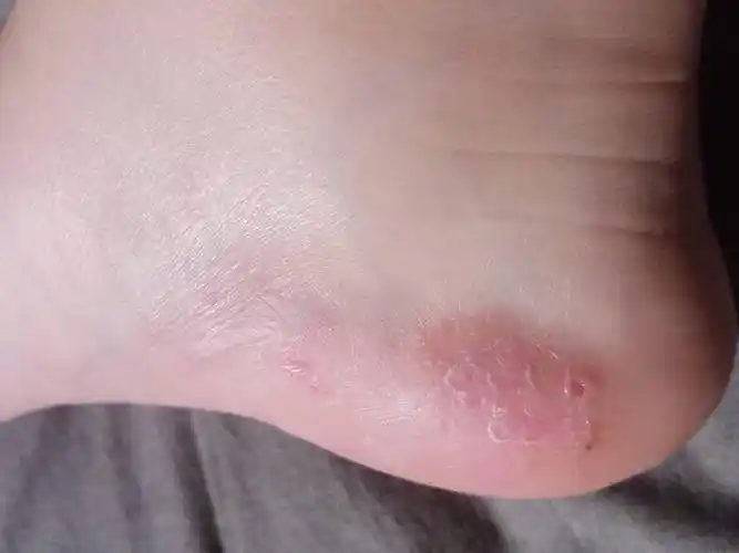 脚上长一堆透明小水泡是怎么回事