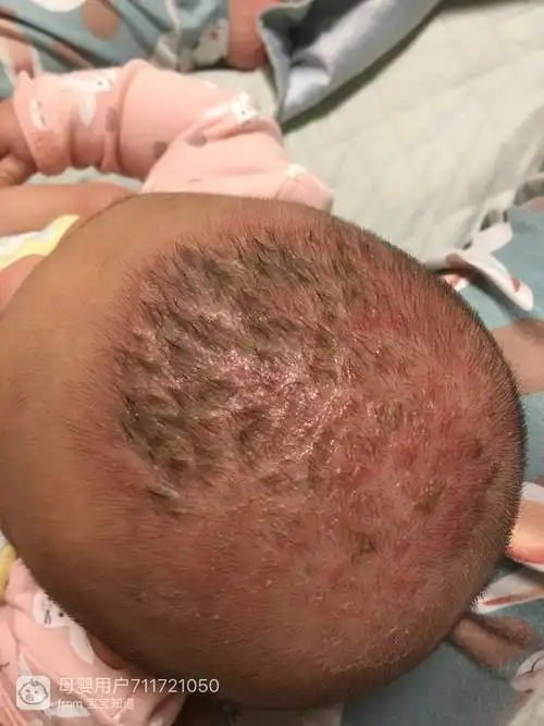 三个月宝宝头上有头垢,然后又长红疙瘩,又红又痒,宝宝去抓