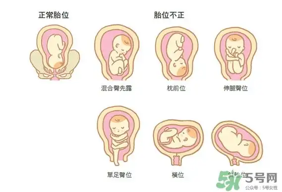 胎位不正如何矫正?胎位不正一定要剖腹产吗?