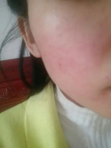 脸上过敏很干要擦什么缓解呢