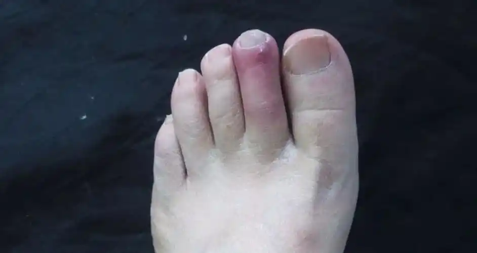 糖尿病足有截肢可能?糖友保护好脚,最好4件事提上日程