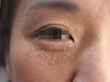 汗管瘤眼周密密麻麻的小疙瘩样丘疹图.jpeg