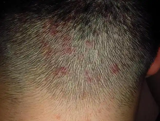 头皮上总能摸到的小疙瘩是什么该怎样去除医生告诉你