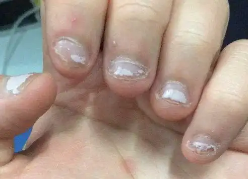 当孩子存在某些心里问题时也会出现啃指甲的行为,这时家长在给孩子