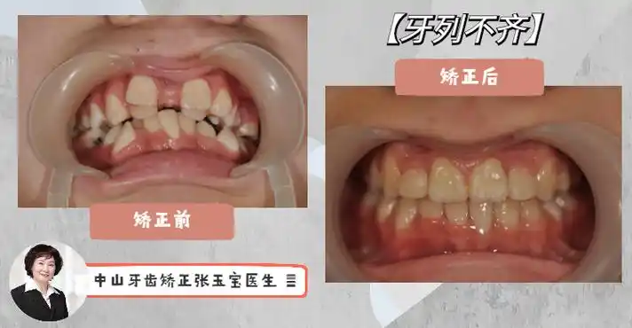 为什么我的孩子会长两排牙齿?该怎么办?