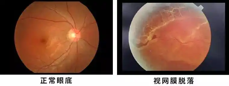 高度近视眼做剧烈运动的风险太高,因为高度近视会使眼轴变长,眼球突出