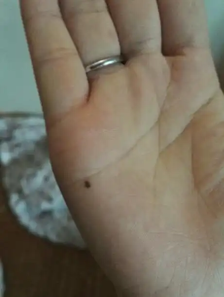 手掌上突然长了一颗痣(手掌突然长了一颗小痣)