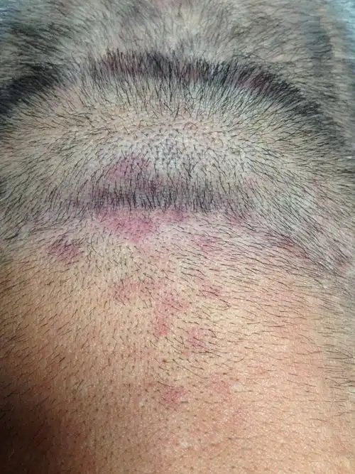 犯时,头皮患处发红,掉大片头皮屑,大