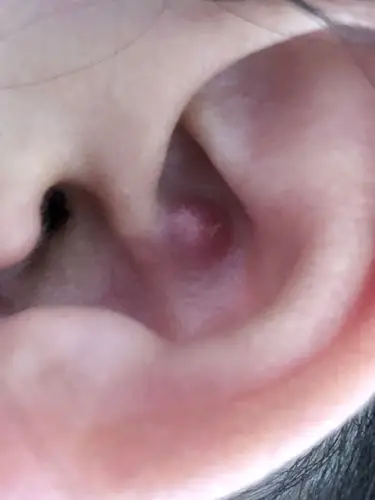 我媳妇耳朵里长个红痘是什么?怎么治?