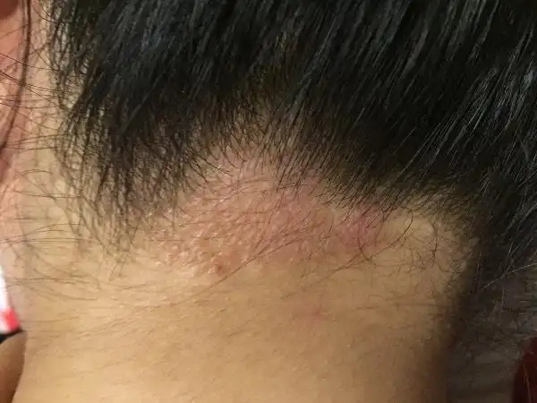 请问这是头皮藓么,已经有几个月了,刚开始以为没什么只是有点痒,现