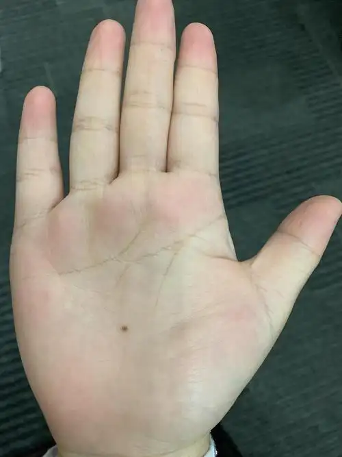 上大学后,手掌心长了一颗痣,有说法吗?