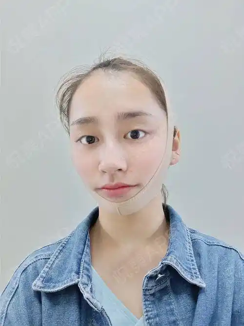 拉皮手术提升术后7天_紧致提升术后7天_除皱抗衰老术后7天_杨杨佳分享