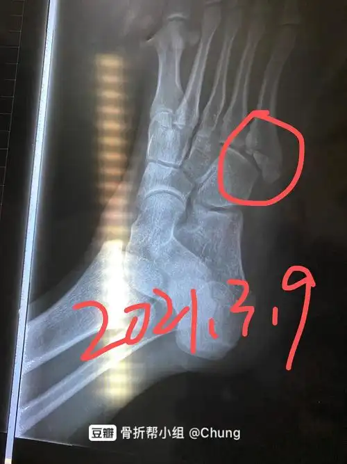 右脚第五跖骨基底部骨折