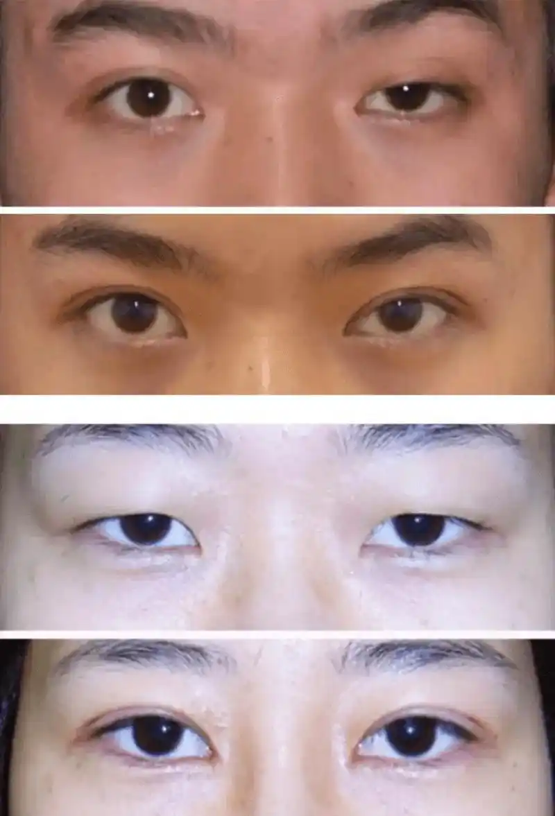 下垂眼睑,是指下眼睑的松弛和下垂,导致眼部外观和功能的问题.