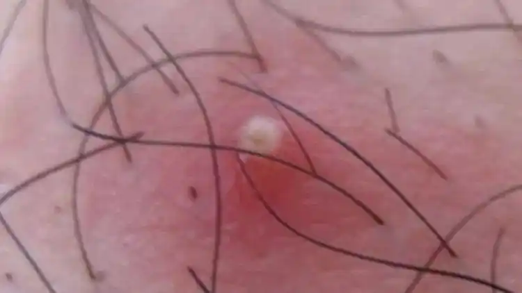 汗出过多,真菌感染,皮肤易得毛囊炎