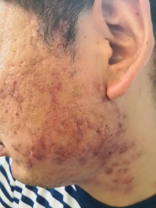 解决皮肤问题专注皮肤美容##马拉色菌毛囊炎##痤疮#系统治疗很重要.